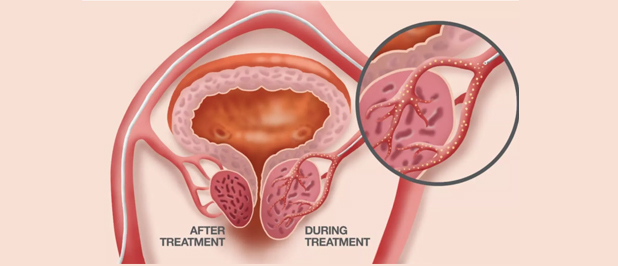 Prostate artery embolization